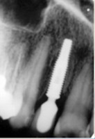 /album/galeria-de-fotos-carga-imediata-apos-exodontia-atraumatica-/carga-imediata-com-exodontia-atraumatica22-jpg/